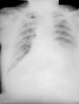 Chest Radiograph During the 4th Day of Anthrax Illness