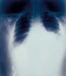 Radiograph of Anthrax Inhalation 22 Hours Before Death