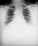 Chest X-ray of a 46 Year Old Man Diagnosed with the Anthrax Disease