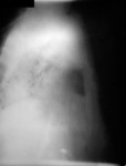 Lateral Chest Radiograph of Anthrax On the 13th Day