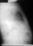 Lateral Chest Radiograph of Anthrax On the 4th Day of Illness