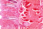 Histopathology Of Large Intestine In Fatal Human Anthrax