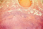 Necrosis Of Lymph Node Due To Anthrax
