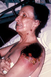 Female Patient with Vaccinia Gangrenosum