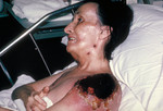 Progressive Vaccinia Gangrenosum On the Shoulder of a Woman