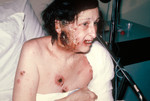 Hospitalized Woman Showing Severe Complications of a Smallpox Vaccination