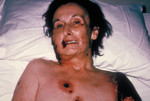 Female Patient with Progressive Vaccinia from a Smallpox Vaccination
