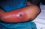 Female Patient Presented with Vaccinia Gangrenosum 1 Month After a Smallpox Vaccination
