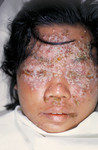 28 Year Old Woman with Eczema Vaccinatum