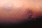 Patient with a Secondary Herpes Infection
