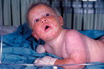 8 Month Old Infant with a Widespread Rash from a Generalized Vaccinia Reaction