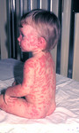 This Child Developed Rrythema Multiforme from a Smallpox Vaccination
