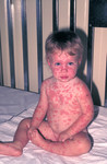 Child that Developed Erythema Multiforme (severe rash) from a Smallpox Vaccine