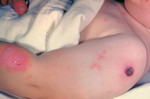Child that Developed Erythema Multiforme from a Vaccination