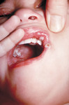 Child with Autoinoculation
