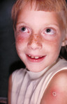 Child with a Case of Autoinoculation of Her Cheek after being Vaccinated with Vaccinia