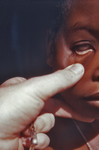 CDC EIS Officer Examining the Palpebral Conjunctiva of a Nigerian Child with Anemia Symptoms