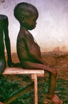 Child with Kwashiorkor Disease from Severe Dietary Protein Deficiency
