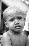Child Infetcted with the Smallpox Disease
